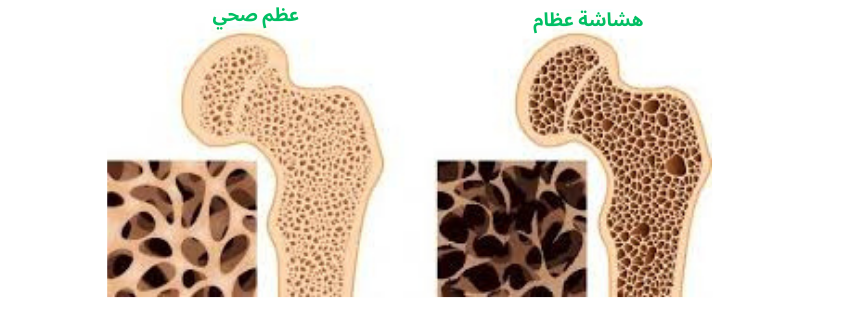 اسباب-هشاشة-العظام