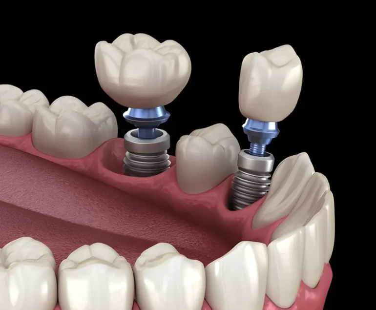 Dental Implants 2