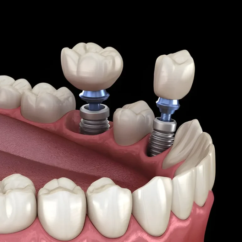 افضل دكتور زراعة اسنان في جدة 3 Dental Implants 2