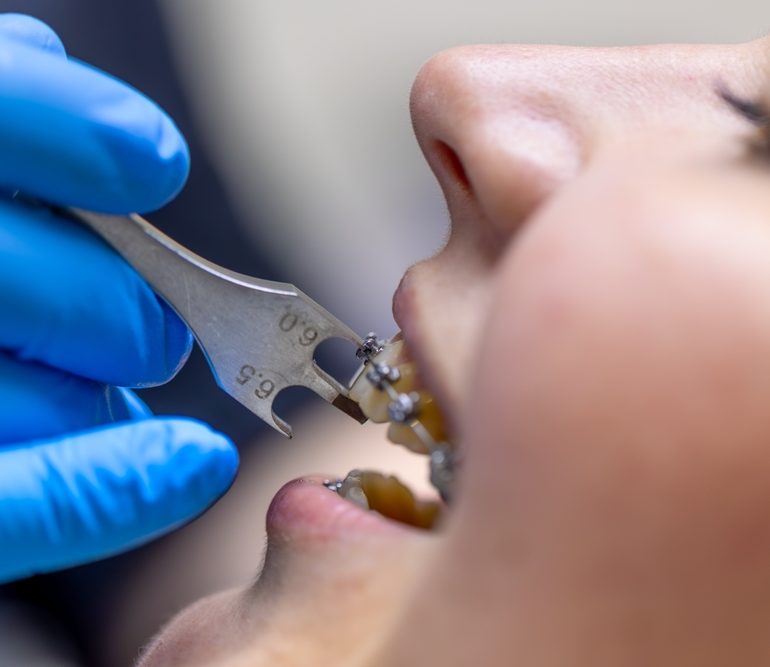 دكتور تقويم اسنان في جدة 5 orthodontic 2