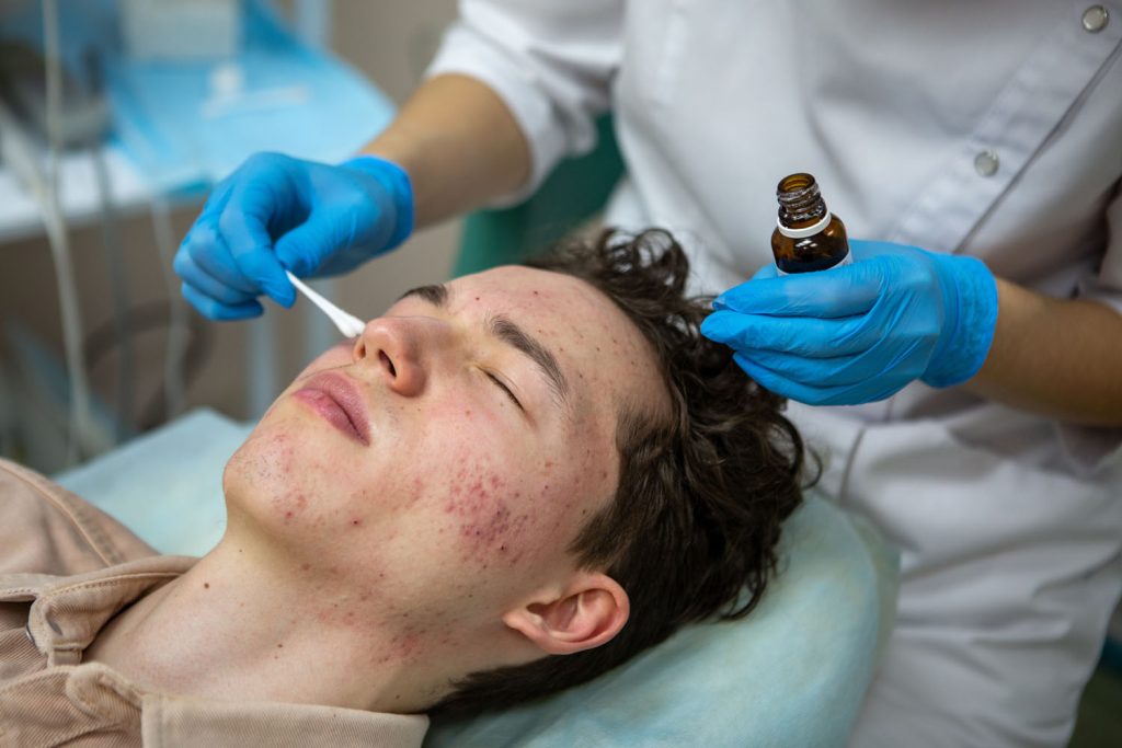 treatment of acne in adolescents facial peeling t 2026 03 13 04 22 09 utc