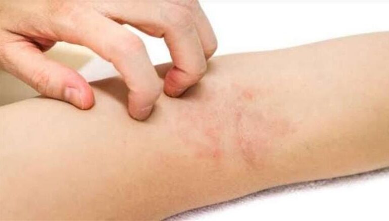 افضل دكتور لعلاج حساسية الجلد
