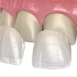 تركيبات اسنان البورسلان