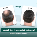 تعليمات قبل وبعد زراعة الشعر