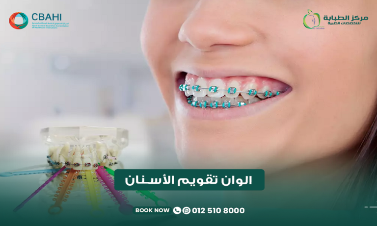 ألوان تقويم الأسنان
