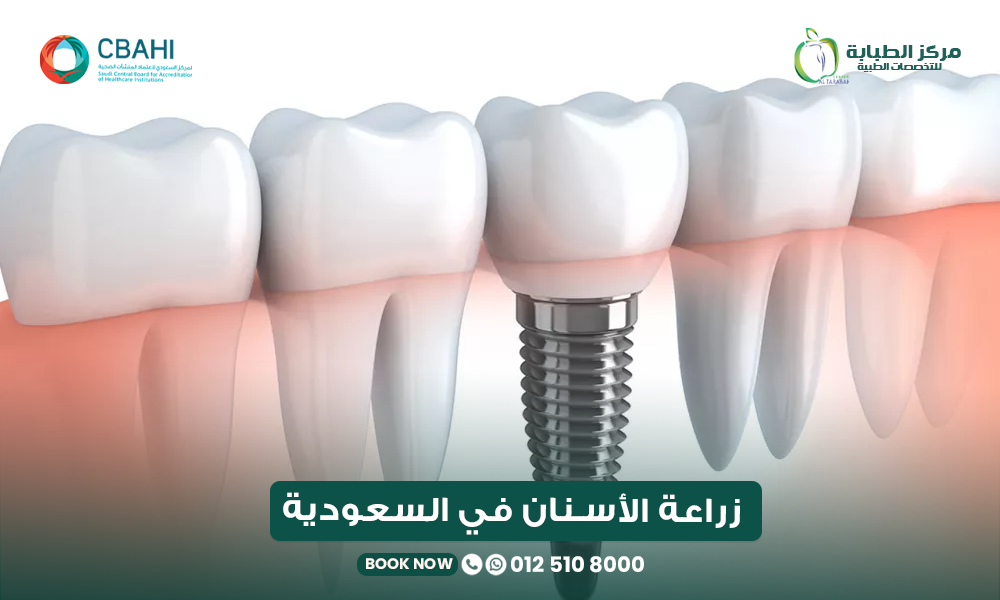 زراعة الأسنان في السعودية بمركز الطبابة