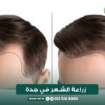 زراعة الشعر في جدة