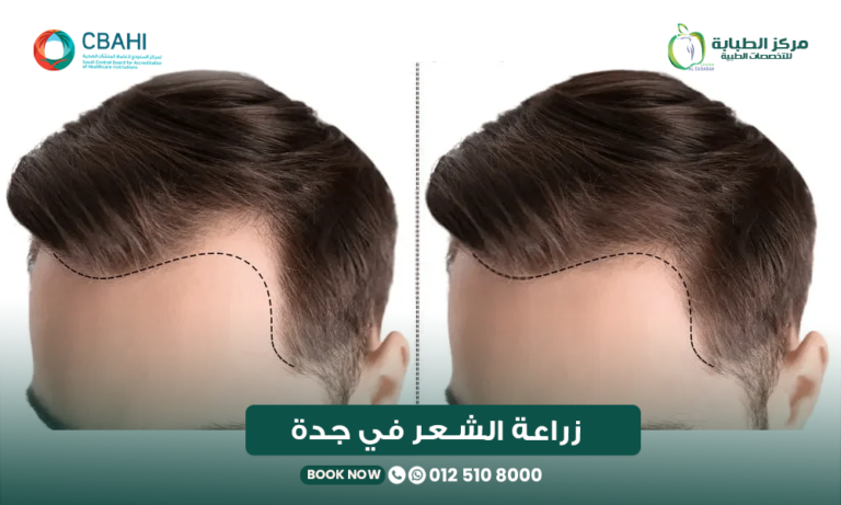 زراعة الشعر في جدة