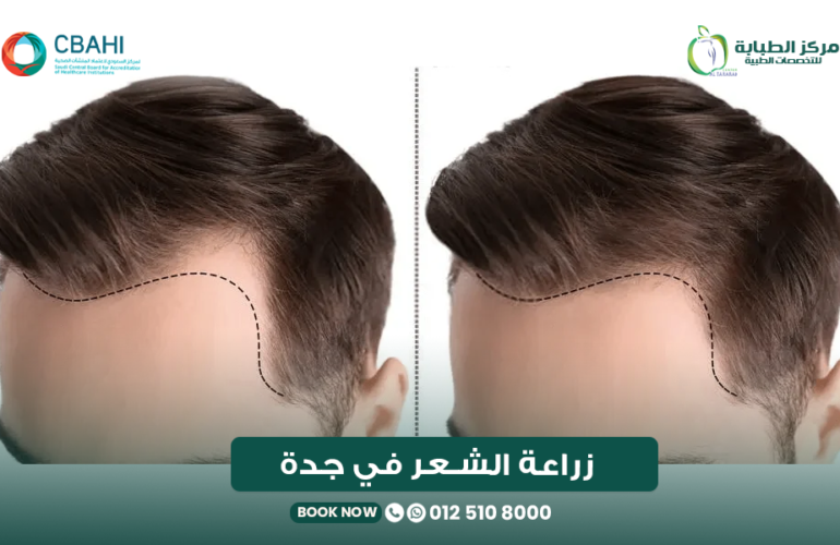 زراعة الشعر في جدة