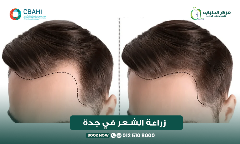 زراعة الشعر في جدة: الدليل الكامل قبل اتخاذ القرار 22 زراعة الشعر في جدة