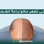 متى تظهر نتائج زراعة الشعر