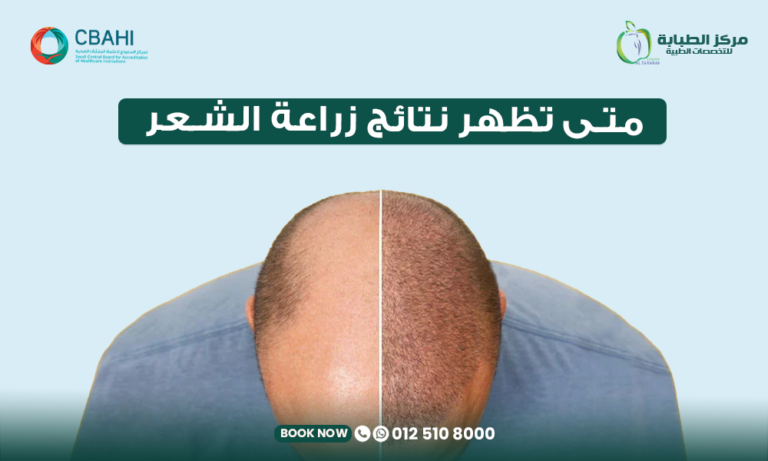متى تظهر نتائج زراعة الشعر
