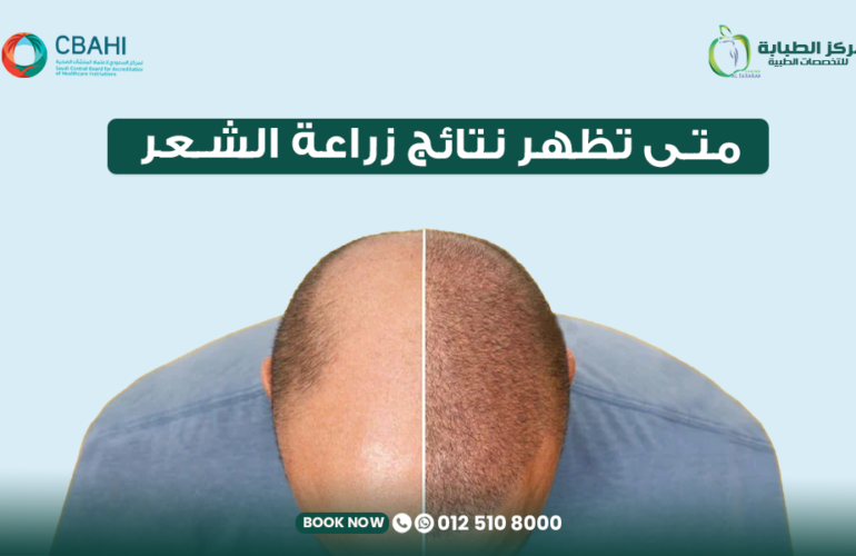 متى تظهر نتائج زراعة الشعر؟ الدليل الكامل لمراحل نمو الشعر من الأسبوع الأول حتى 12 شهرًا 16 متى تظهر نتائج زراعة الشعر
