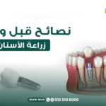 نصائح قبل وبعد زراعة الأسنان