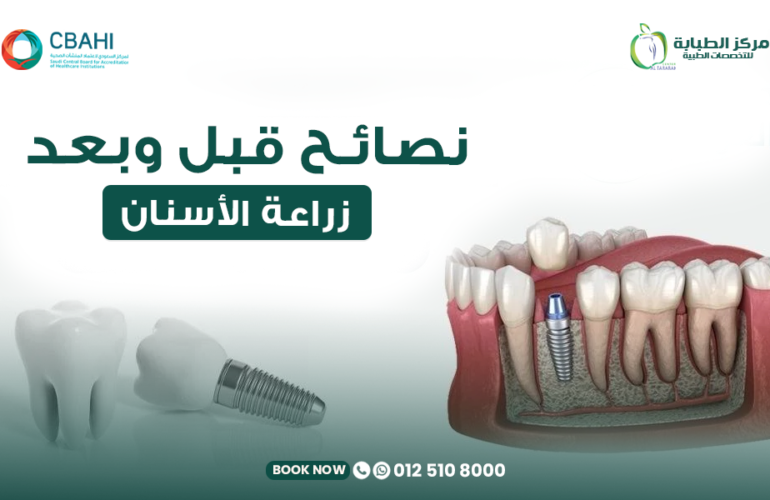 نصائح قبل وبعد زراعة الأسنان