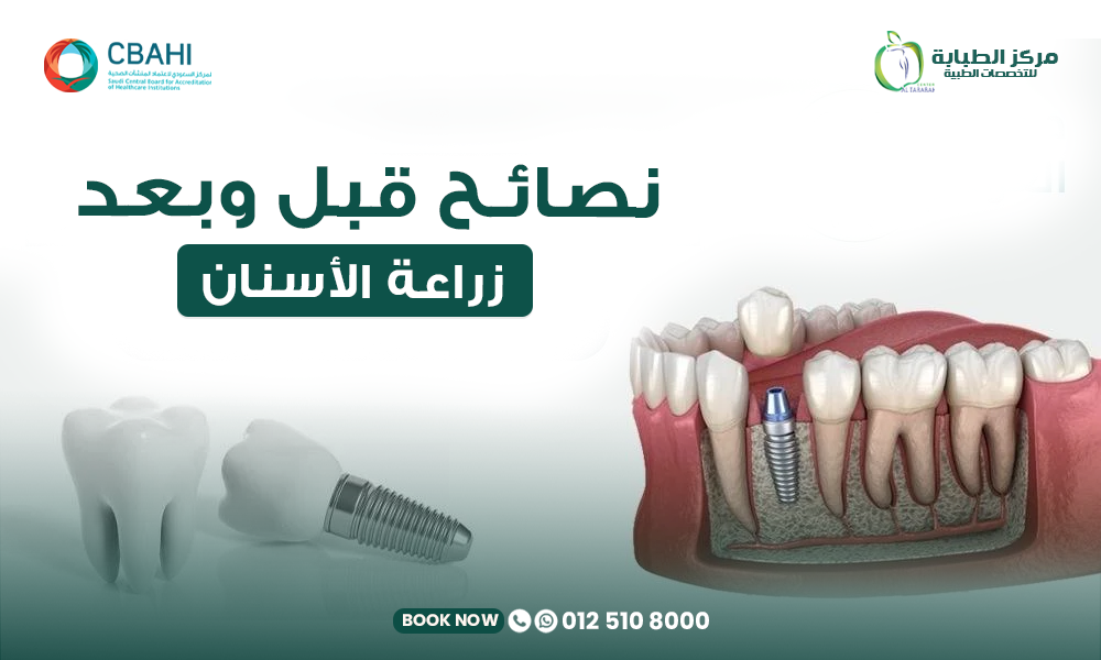 نصائح قبل وبعد زراعة الأسنان