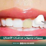 مميزات وعيوب عدسات الأسنان