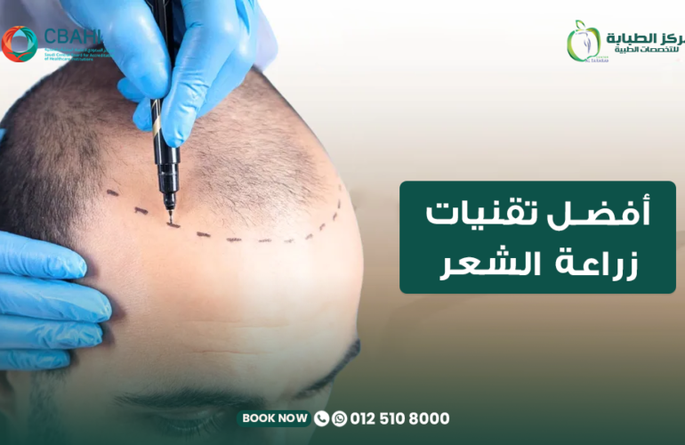 أفضل تقنيات زراعة الشعر