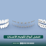 أفضل أنواع تقويم الأسنان