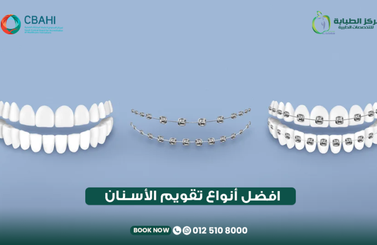 أفضل أنواع تقويم الأسنان