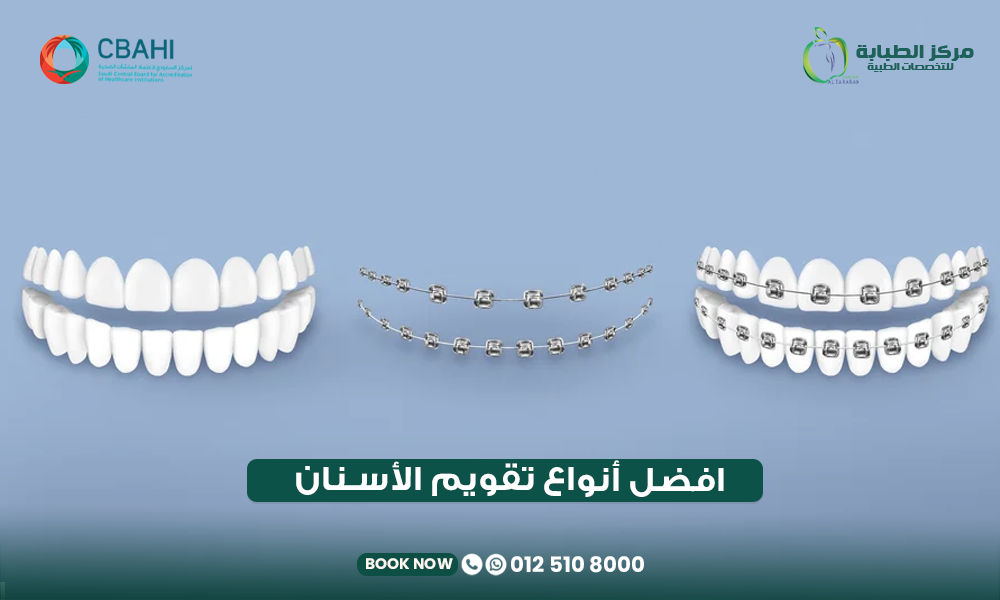 أفضل أنواع تقويم الأسنان