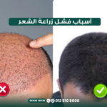 أسباب فشل زراعة الشعر