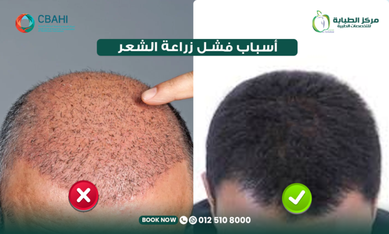 أسباب فشل زراعة الشعر