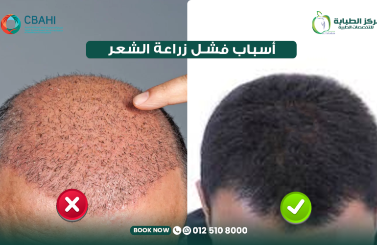 أسباب فشل زراعة الشعر: 15 سببًا قد يؤدي إلى فشل العملية وكيف تتجنبها 26 أسباب فشل زراعة الشعر