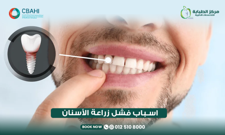 أسباب فشل زراعة الأسنان