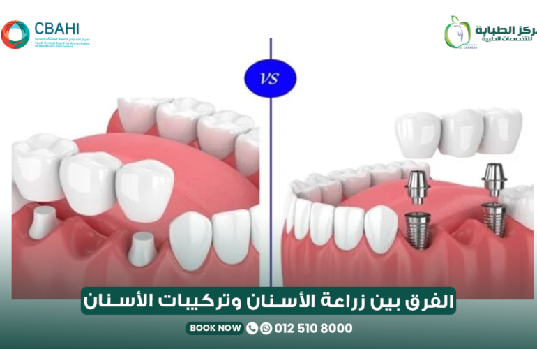 الفرق بين زراعة الأسنان وتركيبات الأسنان
