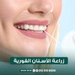 زراعة الأسنان الفورية