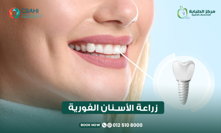 زراعة الأسنان الفورية