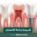 شروط زراعة الأسنان