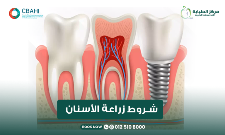 شروط زراعة الأسنان