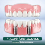 كم تدوم زراعة الأسنان
