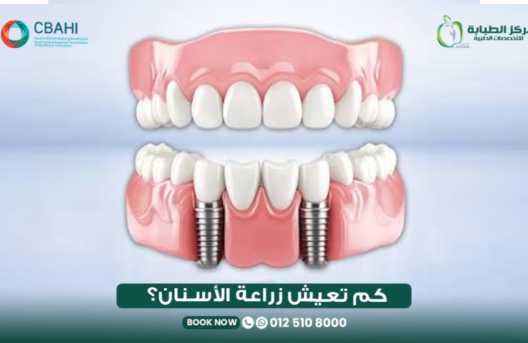 كم تدوم زراعة الأسنان