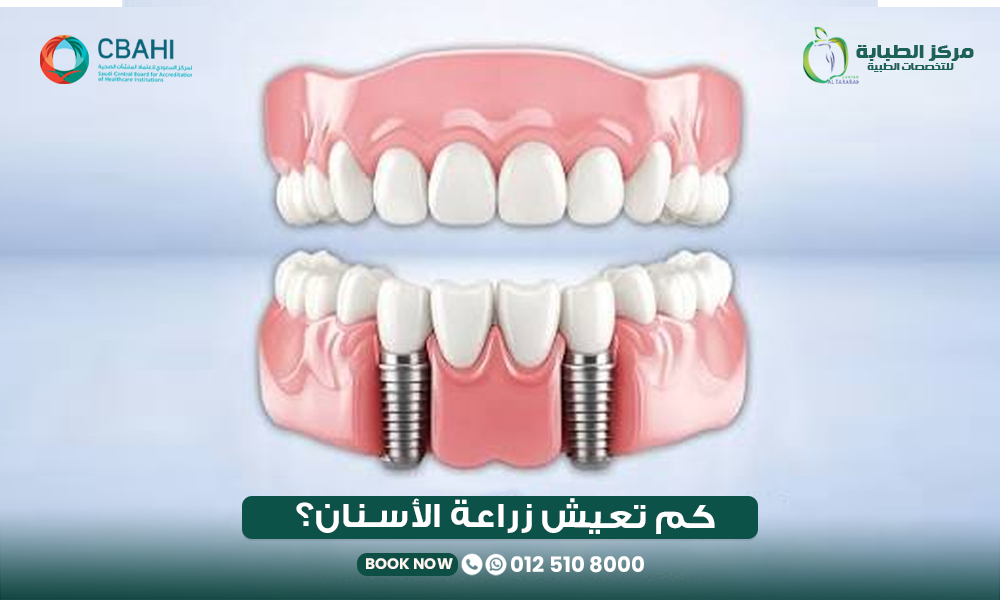 كم تدوم زراعة الأسنان
