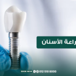 مدة زراعة الأسنان