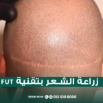 زراعة الشعر بتقنية FUT