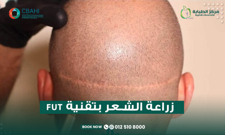 زراعة الشعر بتقنية FUT