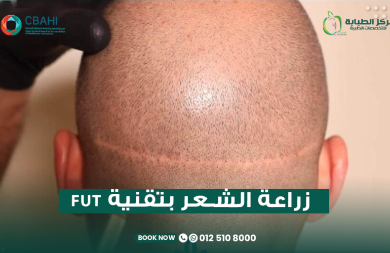 زراعة الشعر بتقنية FUT