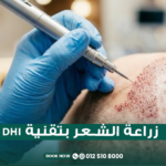 زراعة الشعر بتقنية DHI واقلام تشوي