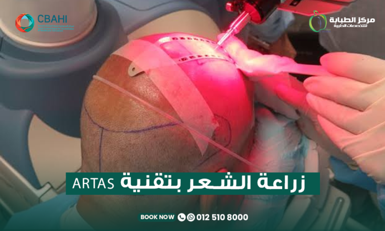 زراعة الشعر بتقنية ARTAS