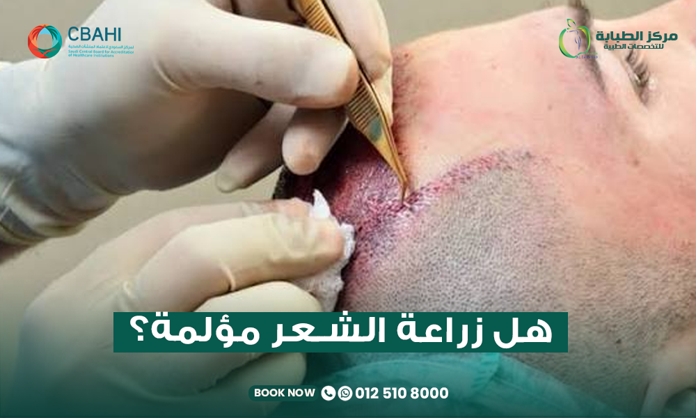 هل زراعة الشعر مؤلمة
