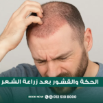 الحكة والقشور بعد زراعة الشعر في مركز الطبابة في جدة