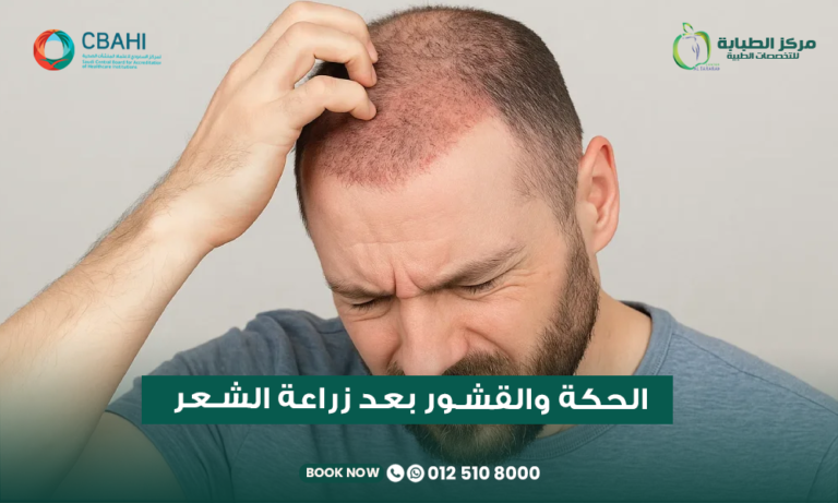 الحكة والقشور بعد زراعة الشعر في مركز الطبابة في جدة