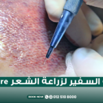 زراعة الشعر بتقنية السفير Sapphire FUE في مركز الطبابة