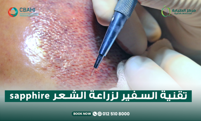 زراعة الشعر بتقنية السفير Sapphire FUE في مركز الطبابة