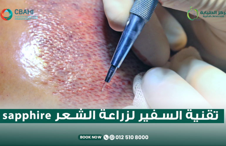 زراعة الشعر بتقنية السفير Sapphire FUE في مركز الطبابة