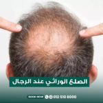 علاج الصلع الوراثي المبكر عند الرجال في مركز الطبابة